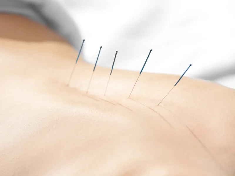 Acupuncture at Towson Integrative Health in Towson