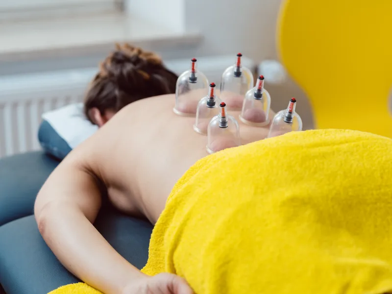 Cupping Therapy at Towson Integrative Health in Towson