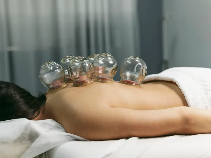 Cupping Therapy at Towson Integrative Health in Towson