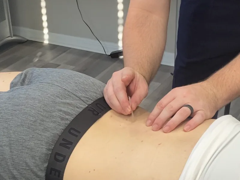 How Dry Needling works at Towson Integrative Health