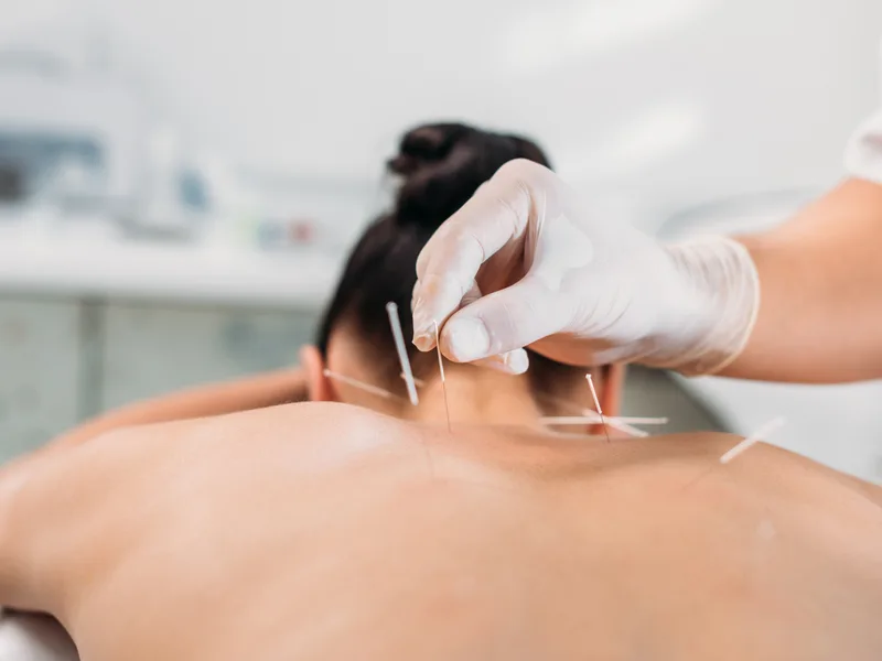 Dry Needling at Towson Integrative Health in Towson